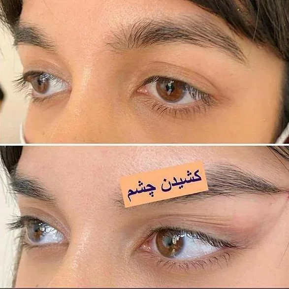کش لیفت ابرو کش لیفت شقیقه